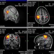 4 angles of an fMRI scan